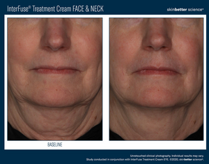InterFuse Treatment Cream / FACE & NECK